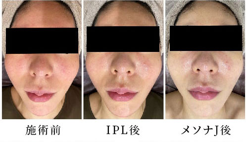 エレクトロポレーション(メソナJ)・IPL症例