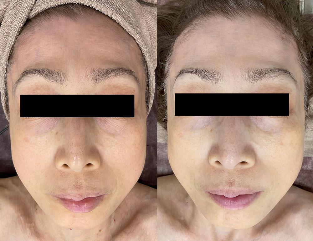 エレクトロポレーション(メソナJ)の症例写真3