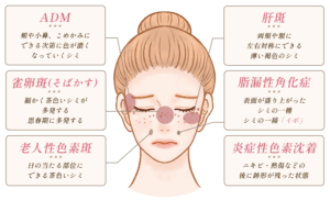 シミ・肝斑の種類