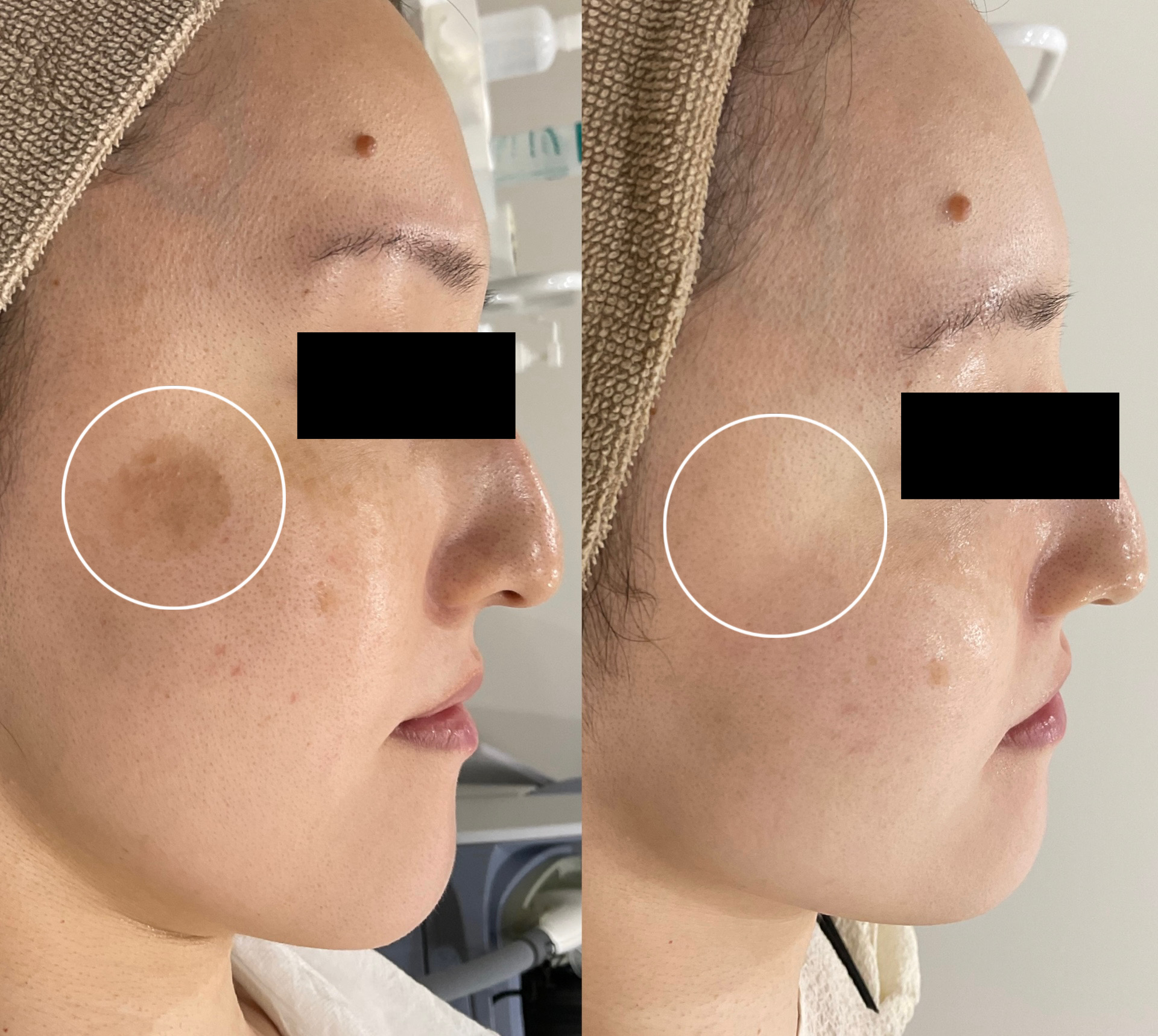 スポットシミ取り30代女性右頬