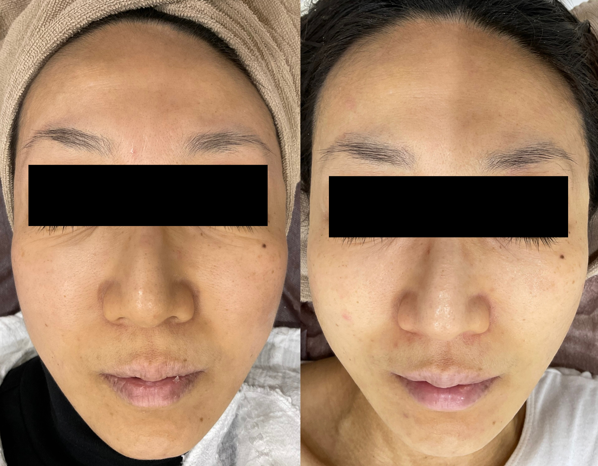 マッサージピール＋メソナ40代女性