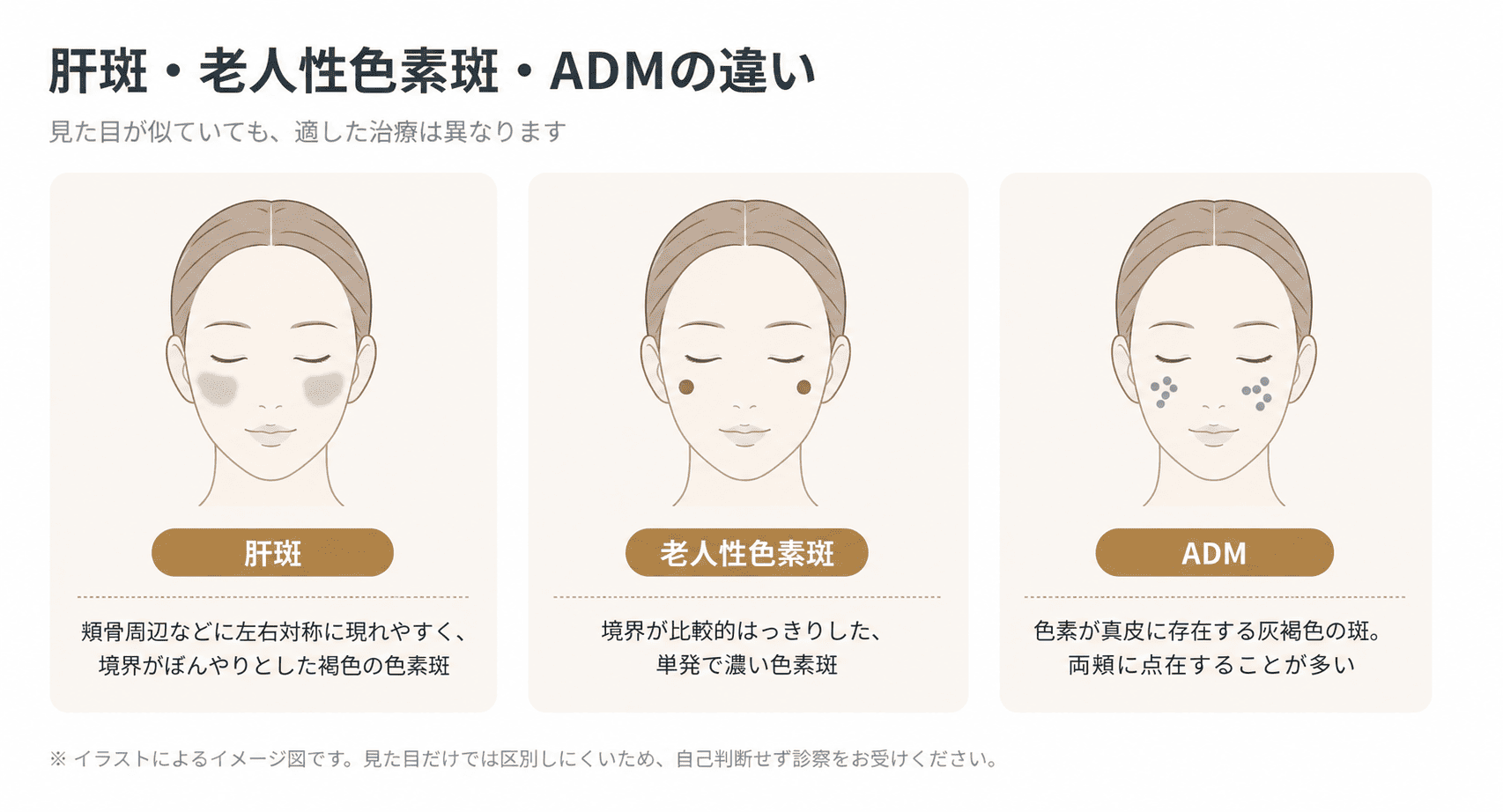 肝斑・老人性色素斑・ADMの見た目と特徴の違いを示したイラスト図