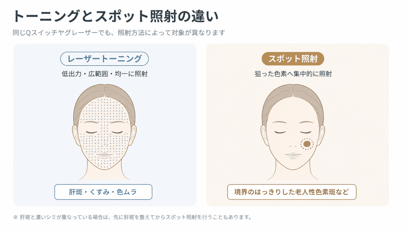 レーザートーニングとスポット照射の照射方法の違いを比較した図