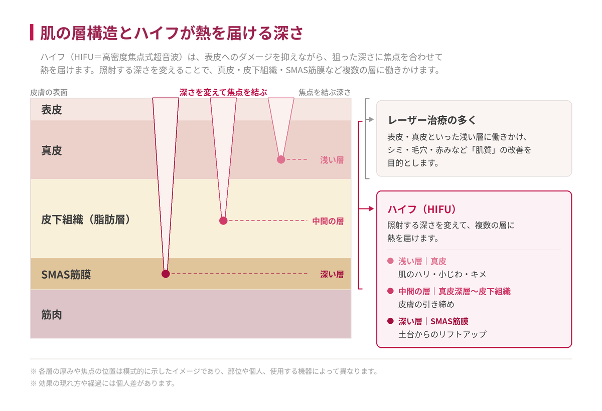 表皮・真皮・皮下組織・SMAS筋膜・筋肉の断面図。ハイフの超音波が浅い層（真皮）・中間の層（真皮深層〜皮下組織）・深い層（SMAS筋膜）でそれぞれ焦点を結ぶ様子と、レーザー治療が働きかける浅い層との違いを示した図