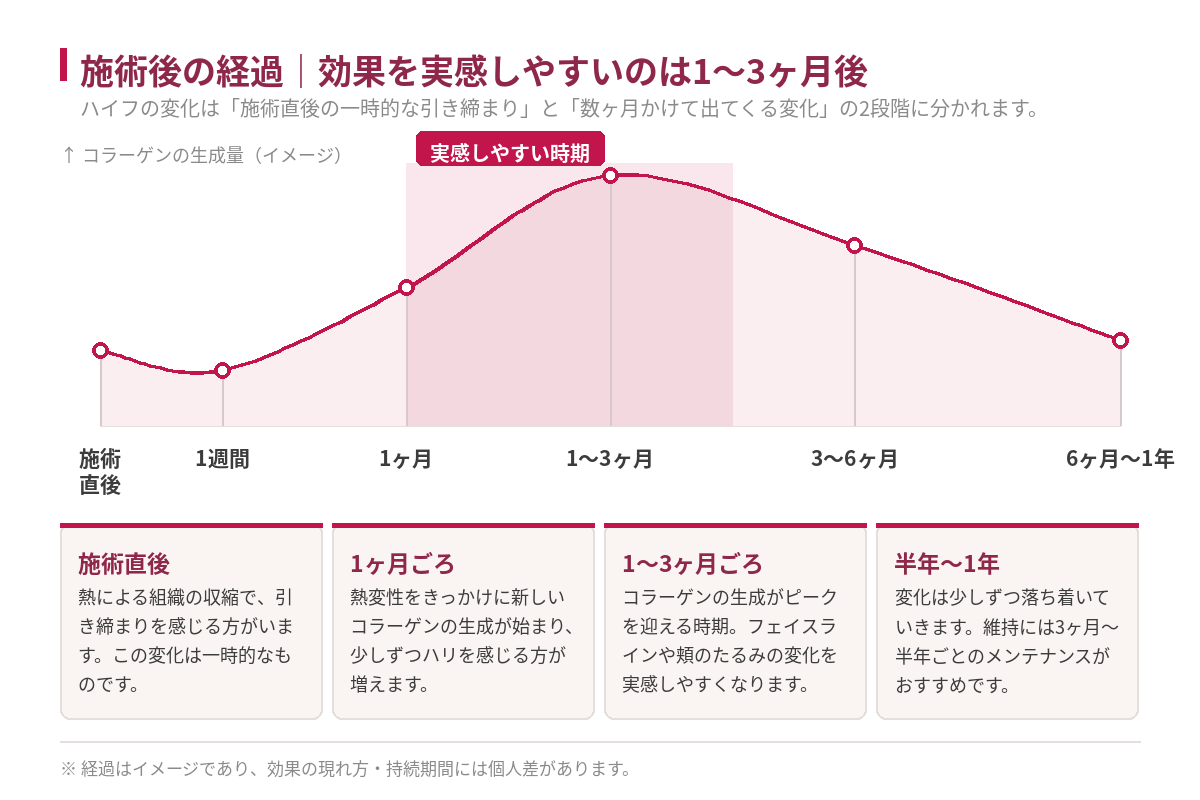 ハイフ施術後のコラーゲン生成量の推移イメージ。施術直後・1週間・1ヶ月・1〜3ヶ月・3〜6ヶ月・6ヶ月〜1年の経過と、実感しやすい時期を示したグラフ