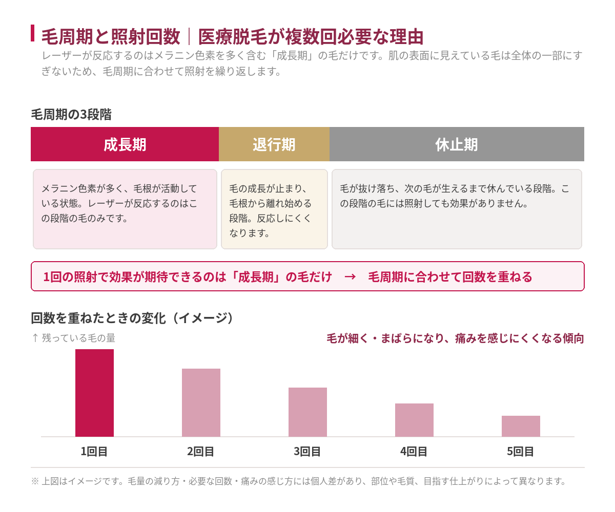 毛周期の3段階（成長期・退行期・休止期）とレーザーが反応する範囲を示した図。あわせて、回数を重ねるごとに残っている毛の量が減っていくイメージを示した棒グラフ