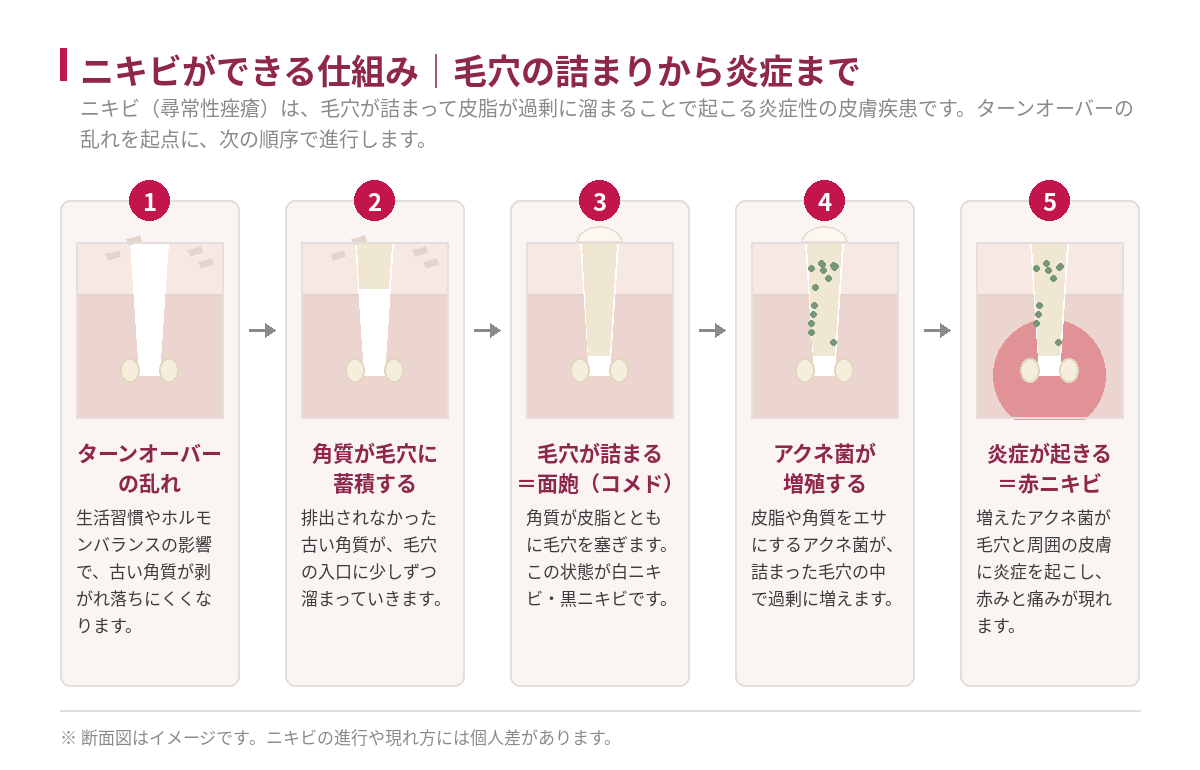 ニキビができる仕組みを5段階で示した断面図。ターンオーバーの乱れ、角質の蓄積、毛穴の詰まり（面皰）、アクネ菌の増殖、炎症（赤ニキビ）の流れを図解したもの