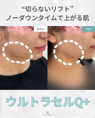 @m.clinic_official

こんにちは🩵
本日は症例写真の紹介です🤞🏻✨

この方はフェイスラインのもたつきに対して
ウルトラセルqプラスをされました☺️

2週間に1回のペースで数回続けることで
効果実感が期待できます✨

二重あご、フェイスラインの
もたつきが気になる方にオススメ👼🏻

フェイスラインのみですと
施術時間は10分ほどなので
隙間時間に無理なく通えます🥰
ダウンタイムがほぼないのが嬉しい❤️

気になる方は是非当院にお越しください❣️

ご予約はお電話、WEB、LINEから承っております🐻

皆様のご来院心よりお待ちしております🫶🏻💞

#大阪美容皮膚科 #美容皮膚科 #梅田美容皮膚科 #エムクリニック #mclinic #プレゼントキャンペーン #3周年 #ドクターズコスメ #welina#高濃度ビタミンC点滴#レーザートーニング#ピーリング#メソナj#ハイドラジェントル#マッサージピール#リジュラン#リジュランスキンブースター#メソナj#肌メンテ#肌管理#フォトフェイシャル#IPL #美白治療#イボ取り#ダーマペン4#ニキビ跡改善#毛穴治療 #シミ取り#ハイフ#たるみ治療#ウルトラセルqプラス