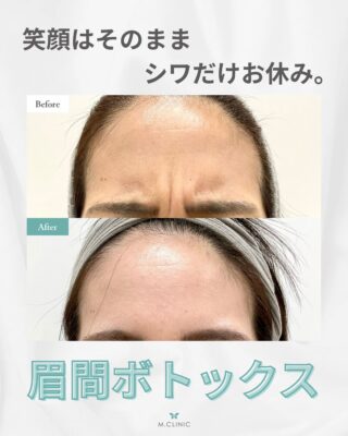 @m.clinic_official

こんにちは🩵
本日は症例写真の紹介です🤞🏻✨

この方は眉間の表情ジワがお悩みで
アラガン社製ボトックスをされました☺️

眉間にシワを寄せづらくなり
つるんとした印象の額になりました🥰

🌱ポイント🌱
・施術時間は1部位につき10分ほどで完了💫
・アラガン社製、韓国製のどちらかを選べます😌
・将来のシワ対策として、シワが気になる前から
　対処しておくことがオススメ💖
・3〜6ヶ月効果が持続するのでコスパも良いです👏🏻

気になる方は是非当院にお越しください❣️

ご予約はお電話、WEB、LINEから承っております🐻

皆様のご来院心よりお待ちしております🫶🏻💞

#大阪美容皮膚科 #美容皮膚科 #梅田美容皮膚科 #エムクリニック #mclinic #プレゼントキャンペーン #3周年 #ドクターズコスメ #welina#高濃度ビタミンC点滴#レーザートーニング#ピーリング#メソナj#ハイドラジェントル#マッサージピール#リジュラン#リジュランスキンブースター#肌メンテ#肌管理#フォトフェイシャル#IPL #美白治療#CO2レーザー#エッジワン