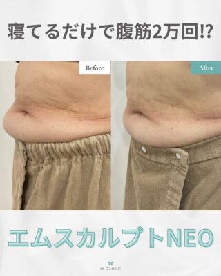 @m.clinic_official

こんにちは🩵
本日は症例写真の紹介です🤞🏻✨

この方はお腹のたるみがお悩みで
エムスカルプトNEOをされました☺️

ガウンに乗っていたハミ肉がこんなに減りました✨
痩身✖️筋力UPならエムスカルプトneo！！🥰

🌱ポイント🌱
・気になる部位の部分痩せやヒップアップに🤭
・運動が苦手で、楽して痩せたい方にオススメ💖
・施術時間はたったの30分！寝ているだけでOK🙆🏼‍♀️
・脂肪燃焼と筋力UPを同時に行うことで
　リバウンドしにくい体へ💪🏼💕

気になる方は是非当院にお越しください❣️

ご予約はお電話、WEB、LINEから承っております🐻

皆様のご来院心よりお待ちしております🫶🏻💞

#大阪美容皮膚科 #美容皮膚科 #梅田美容皮膚科 #エムクリニック #mclinic #プレゼントキャンペーン #3周年 #高濃度ビタミンC点滴#レーザートーニング#ピーリング#メソナj#ハイドラジェントル#マッサージピール#リジュラン#リジュランスキンブースター#肌メンテ#肌管理#フォトフェイシャル#IPL #医療ダイエット#医療痩身#エムスカルプトneo
