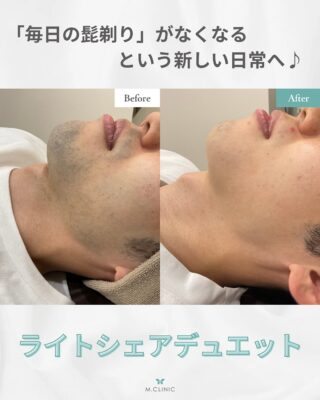 @m.clinic_official

こんにちは🩵
本日は症例写真の紹介です🤞🏻✨

この方は濃いヒゲがお悩みで
当院のヒゲ脱毛10回コースをされました☺️

全体的に濃かった髭がこんなに薄くなりました✨
4週間おきに1回のペースで継続する事で
効果を発揮します🥰

冷却機能のあるハンドピースを使用し、
必要であれば表面麻酔もご用意しておりますので
痛みが心配な方も安心して受けていただけます🌱
※麻酔代は別途¥3,300かかります

気になる方は是非当院にお越しください❣️

ご予約はお電話、WEB、LINEから承っております🐻

皆様のご来院心よりお待ちしております🫶🏻💞

#大阪美容皮膚科#梅田美容皮膚科#美容皮膚科#mclinic #ハイドラジェントル#ワキボトックス#ipl#レーザートーニング#レーザータイトニング#マッサージピール#メソナJ#メソナj大阪#エムスカルプトneo #医療脱毛#ライトシェアデュエット#熱破壊式脱毛レーザー
