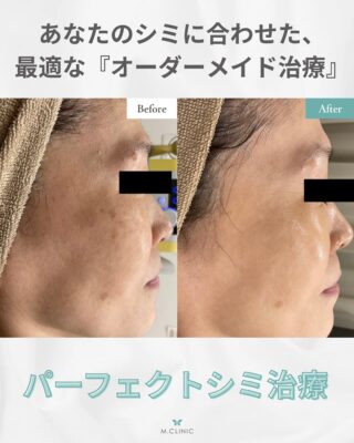 @m.clinic_official

こんにちは🩵
本日は症例写真の紹介です🤞🏻✨

この方はシミ・肝斑がお悩みで
パーフェクトシミ治療を3クールされました☺️

シミや肝斑が目立たなくなり
シワの改善やキメの細やかさが出てきています💫

当院のパーフェクトシミ治療は
複数の施術を組み合わせて
よりしっかりとシミにアプローチしていく
治療方法になります😌🌱

🎀Point🎀
・複数の施術を組み合わせることで相乗効果が💖
・シミや肝斑の治療には時間がかかります🥲
　腰を落ち着けて定期的に続けていくことが大切❤️‍🩹
・継続特典を利用してお得に続けていきましょう🥰

シミや肝斑でお悩みの方に
最も人気のコンビネーション治療✨
気になる方は是非当院にお越しください❣️

ご予約はお電話、WEB、LINEから承っております🐻

皆様のご来院心よりお待ちしております🫶🏻💞

#大阪美容皮膚科#梅田美容皮膚科#美容皮膚科#mclinic #ハイドラジェントル#ワキボトックス#ipl#レーザートーニング#レーザータイトニング#マッサージピール#メソナJ#メソナj大阪#パーフェクトシミ治療#シミ対策#シミ治療