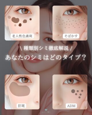@m.clinic_official

こんにちは💖
今回はシミの種類とそれぞれのシミに
適した治療をご紹介します🤭💫

そのシミ、実は種類によって
治療法が違うって知ってましたか？🤔
 シミのタイプを間違えると
なかなか消えない原因に…！
 それぞれに合った治療法をチェックして
自分にピッタリのケアを見つけましょう🌿

見返せるように【保存】しておくのがおすすめ🩵

#大阪美容皮膚科#梅田美容皮膚科#美容皮膚科#mclinic #ipl#レーザートーニング#レーザータイトニング#シミ治療#肌トラブル #シミ対策#保存推奨#美白ケア#シミの種類