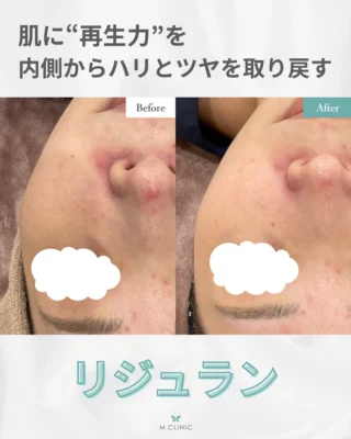 @m.clinic_official

こんにちは🩵
本日は症例写真の紹介です🤞🏻✨

この方は毛穴や目の下の小ジワがお悩みで
リジュラン(手打ち)をされました☺️
※施術前と施術10日後の比較写真になります📸

目の下のクマや小じわが改善されています👏🏻✨
頬の毛穴も引き締まっていますね🥰

初期治療として2〜4週間に1回のペースで
3〜4回受け、その後はメンテナンスとして
3〜6ヶ月に1回程度行うのが標準的です🩵
※麻酔代は別途¥3,300かかります

気になる方は是非当院にお越しください❣️

ご予約はお電話、WEB、LINEから承っております🐻

皆様のご来院心よりお待ちしております🫶🏻💞

#大阪美容皮膚科#梅田美容皮膚科#美容皮膚科#mclinic #ハイドラジェントル#ワキボトックス#ipl#レーザートーニング#レーザータイトニング#マッサージピール#メソナJ#メソナj大阪#リジュラン#アンチエイジング#若返り