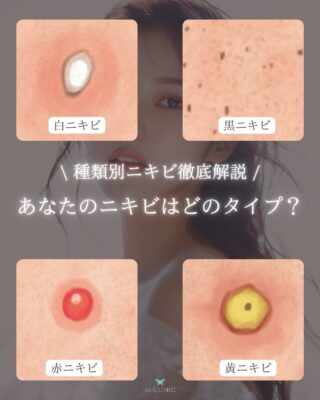 @m.clinic_official

こんにちは💖
今回はニキビの種類とそれぞれのニキビに
適した治療をご紹介します🤭💫

そのニキビ、実は種類によって
治療法が違うって知ってましたか？🤔
 ニキビのタイプを間違えると
なかなか消えない原因に…！
 それぞれに合った治療法をチェックして
自分にピッタリのケアを見つけましょう🌿

見返せるように【保存】しておくのがおすすめ🩵

#大阪美容皮膚科#梅田美容皮膚科#美容皮膚科#mclinic #ipl#レーザートーニング#レーザータイトニング#ニキビ治療#肌トラブル#ニキビ対策#保存推奨#美肌ケア#ニキビの種類