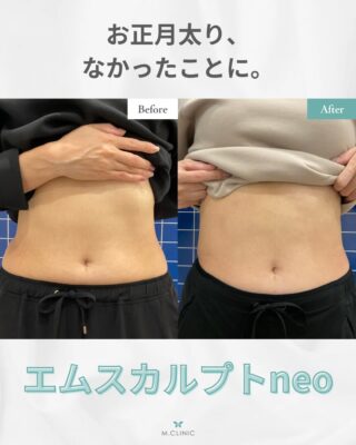 @m.clinic_official 

【症例紹介✨エムスカルプトNEO】
40代女性／腹部 エムスカルプトNEO施術後の症例です😊

気になるお腹まわりの脂肪が減少し、すっきりとした印象に🤍 
エムスカルプトNEOは
✔ 高密度焦点式電磁（HIFEM）＋RF（高周波）を同時に照射
✔ 脂肪細胞の減少＋筋肉量アップを同時に目指せる
✔ 切らない・注射なしの非侵襲的治療
✔ 寝ているだけでOK、ダウンタイムほぼなし
という楽して痩せたい方にオススメの施術です🥰

✔ 運動が苦手 ✔ ダイエットしてもお腹だけ落ちにくい ✔ お正月太りが気になる
✔部分痩せしたい

そんな方にもおすすめ✨

腹部、二の腕、太もも、ふくらはぎ、お尻が対象部位です🌟
 30分間寝ているだけで施術が受けられるため、忙しい方にも人気です。
お気軽にご相談ください🌿

#エムスカルプトNEO
#医療ダイエット
#医療痩身 #部分痩せ #お正月太り解消 美容皮膚科 エムスカルプト 症例紹介