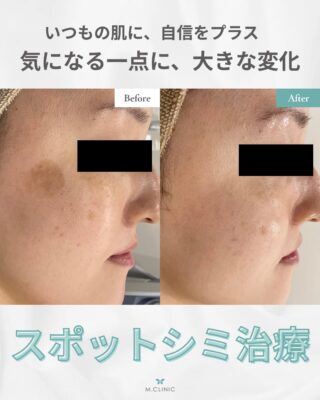 @m.clinic_official 

【症例紹介📸】 30代女性／スポットシミ取り
左頬上部にあった大きめのシミが、スポット治療でここまでキレイに✨ メイクで隠していたシミがなくなると、肌全体の印象がぐっと明るくなります。
「長年気になっていたシミを取りたい」 「ピンポイントでしっかり治療したい」 そんな方におすすめの治療です。

※治療内容・経過には個人差があります

💰料金
⚫︎5mm×5mm : ¥4,400
⚫︎1cm×1cm : ¥8,800
⚫︎取り放題(5個まで) : ¥17,600
⚫︎取り放題(10個まで) : ¥26,400

気になる方はお気軽にご相談ください🌿

#大阪美容皮膚科 #シミ取り #美容医療 #シミ治療 #症例写真