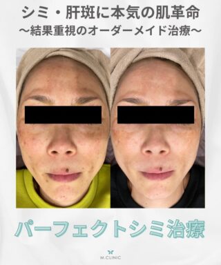 @m.clinic_official 

【シミ・肝斑でお悩みの方へ✨】

当院の**パーフェクトシミ治療（1クール5回）**の症例をご紹介します❣️
マッサージピール・レーザートーニング・IPL・メソナJを組み合わせたコンビネーション治療により、
 ✔︎ 肌全体のトーンアップ ✔︎ シミの改善 ✔︎ 肝斑の改善

回数を重ねるごとに、透明感のある明るいお肌へ導きます✨

今回の症例では、肌全体のくすみが改善し、シミや肝斑が薄くなりました😌 継続することで、さらなる改善も期待できます🩵

「シミも肝斑も両方気になる…」 「どの治療を選べばいいか分からない…」
そんな方におすすめの、複数の治療を組み合わせたオーダーメイド治療です🌿

お気軽にカウンセリングでご相談ください🥰

ご予約は、WEB、LINE、お電話から承っております！
皆様のご来院心よりお待ちしております✨✨

#大阪美容皮膚科 #シミ治療 #肝斑治療 #メソナj 
#マッサージピール