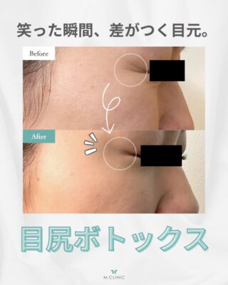@m.clinic_official 

【20代女性　目尻ボトックス症例】

笑った時に出る目尻のシワが気になるとのことで、ボトックス治療を行いました✨
年齢に関わらず、表情ジワは早めのケアがおすすめです😌

目尻のボトックスは、シワをしっかり抑えながらも「効かせすぎない」ことで、自然な笑顔をキープできるのがポイント◎
今回もナチュラルな仕上がりで、やわらかく優しい印象のお目元に仕上がりました💕

☑︎笑うと目尻にシワが寄る
☑︎将来のシワ予防をしたい
☑︎若々しく明るい印象にしたい
☑︎自然に印象をアップしたい

そんな方にぴったりの施術です💡

個人差はありますが、施術後2〜3日ほどで少しずつ効果が現れ、1週間前後で完成することが多いです。
ダウンタイムもほとんどなく、忙しい方でも受けやすいのも魅力の1つです💉

ボトックスは3〜6ヶ月効果が持続します❣️

定期的にメンテナンスすることで、シワの定着予防にもつながります😊

気になる方はカウンセリングにてお気軽にご相談ください✨✨

ご予約は、WEB、LINE、お電話から承っております♪

#大阪美容皮膚科 #目尻ボトックス #シワ予防 #エイジングケア #症例紹介