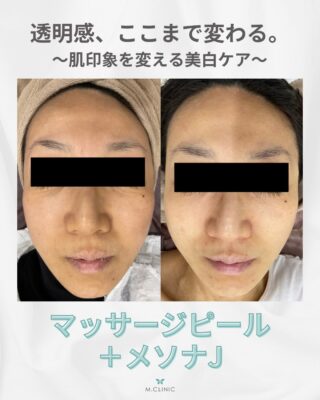@m.clinic_official

＼肌の透明感、諦めていませんか？👀／

マッサージピール＋メソナJを3回施術された40代女性の患者様の症例です🌿
(※初回のみハイドラジェントル併用)

肌全体のくすみが改善し、透明感がアップ✨
さらに、色素沈着も徐々に薄くなり、明るく均一な肌印象へ導いています。

マッサージピールは、肌の深部に働きかけてコラーゲン生成を促進し、ハリ・ツヤ・透明感を引き出す施術💕

さらにメソナJを組み合わせることで、美白やエイジングケアに有効な成分をお肌の奥まで浸透させ、より高い美肌効果が期待できます✨

【相乗効果】
✓ くすみ改善・トーンアップ
✓ 色素沈着の改善サポート
✓ ハリ・ツヤアップ
✓ 肌質改善
✓ 乾燥対策・保湿力向上

「なんとなく肌が暗く見える」
「色素沈着やくすみが気になる」
「透明感のある肌を目指したい」
そんな方におすすめの組み合わせです💎

今なら6月限定のお得なキャンペーンも実施中🥰
気になる方は、大阪梅田の美容皮膚科M.CLINIC(エムクリニック)へお越しください🩵

ご予約はWEB、LINE、お電話から承っております✨

#マッサージピール #メソナJ #肌質改善 #美容皮膚科 #大阪美容皮膚科