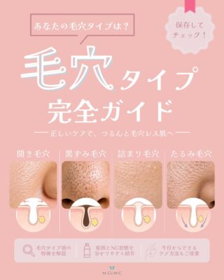 @m.clinic_official

「毛穴ケアを頑張っているのに、なかなか改善しない…😢」

実は毛穴には種類があり、それぞれ原因や必要なケアが異なります。

✔ 開き毛穴
✔ 黒ずみ毛穴
✔ 詰まり毛穴
✔ たるみ毛穴

あなたの毛穴悩みはどのタイプですか？🤔
間違ったケアを続けると、かえって毛穴悩みが悪化してしまうことも。

今回の投稿では、
🔍 毛穴の特徴
🔍 主な原因
🔍 悪化させるNG習慣
🔍 おすすめのケア方法
をわかりやすくまとめました✨

気になる方は保存して、毎日のスキンケアの参考にしてください📌

まずは自分の毛穴タイプを知ることが、美肌への第一歩。
セルフケアだけでは改善が難しい毛穴改善には、美容医療という選択肢もあります🌿

「自分の毛穴タイプがわからない」
「どんな施術が合うか知りたい」
そんな方は大阪梅田の美容皮膚科M.CLINIC(エムクリニック)までお気軽にご相談ください😊

ご予約は、WEB、LINE、お電話から承っております💕

#毛穴改善 #ハイドラジェントル #リジュラン #スキンケア #美容皮膚科