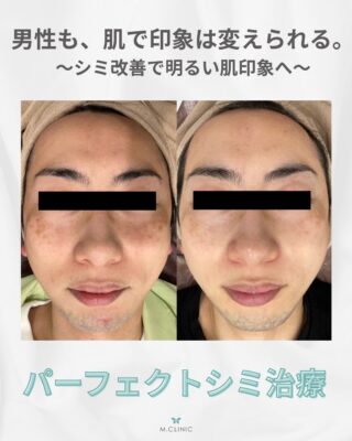 @m.clinic_official
40代男性 シミはここまで変わる。

【40代男性 症例紹介📸】

「年齢とともにシミが増えてきた…」
「清潔感のある肌を目指したい」
そんなお悩みでご来院された40代男性の症例をご紹介します✨

今回受けていただいたのは、
💎パーフェクトシミ治療（9回）
✔ マッサージピール
✔ レーザートーニング
✔ IPL
✔ メソナJ
さらに、気になるシミにはスポット照射によるシミ取りも組み合わせました。

複数の治療をお肌の状態に合わせて組み合わせることで、全体の肌トーンが明るい印象となり、気になっていたシミも目立ちにくい印象へ✨

シミは種類や深さが異なるため、お一人おひとりに適した治療をご提案することが大切です。

「何を選べばいいかわからない」
「自分のシミに合った治療を知りたい」
そんな方も、まずはお気軽にご相談ください😊

男性の美容医療も、今では特別なものではなく、身だしなみの一つとして選ばれる方が増えています✨

大阪梅田の美容皮膚科M.CLINIC(エムクリニック)では、肌診断を活用し、丁寧な診察でお一人おひとりに合わせた治療をご提案しています💕

ご予約はWEB、LINE、お電話から🌟
皆様のご来院心よりお待ちしております🤍

#美容皮膚科 #シミ治療 #メンズ美容 #レーザートーニング #メソナJ