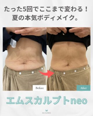 @m.clinic_official

✨エムスカルプトneo 5回でここまで変わる！
50代女性の腹部症例をご紹介✨

「運動しても、お腹だけなかなか痩せない…😣」
「年齢とともにお腹周りが気になってきた💭」
そんなお悩みをお持ちの方へ🌿

今回は、50代女性・エムスカルプトneo腹部5回施術の症例をご紹介します😊

施術後は、腹部の脂肪が大幅に減少し、気になっていたはみ肉もすっきり✨
ウエストラインが引き締まり、引き締まった印象になりました👏

エムスカルプトNEOは、脂肪細胞へアプローチしながら、同時に筋肉を鍛え、引き締めることができるボディメイク治療です💪✨

「脂肪を減らす」と「引き締める」を同時に目指せるため、運動が苦手な方や、効率よくボディラインを整えたい方にもおすすめです😊

📍こんな方におすすめ
✔ お腹周りの脂肪が気になる方
✔ 年齢とともに体型の変化を感じている方
✔ 運動が苦手・忙しくて続けられない方
✔ メリハリのあるボディラインを目指したい方
✔ 夏に向けてボディメイクを始めたい方🌻

※効果には個人差があります。
※施術可能部位 : 腹部、ヒップ、二の腕、ふくらはぎ、太もも

「自分にも合うかな？🤔」という方も、お気軽にご相談ください✨
大阪梅田の美容皮膚科M.CLINIC(エムクリニック)では、お一人おひとりのお悩みに合わせて、最適な治療をご提案いたします😊

ご予約は、WEB、LINE、お電話からお待ちしております❣️

#大阪美容皮膚科 #エムスカルプトNEO #症例紹介 #ダイエット #ボディメイク