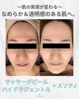@m.clinic_official 

＼たった2回の施術で、肌印象がここまで変化✨／

「肌のざらつきが気になる」
「毛穴が目立つ」
「くすんで見える…」

そんなお悩みをお持ちだった患者様の症例をご紹介します💎

今回は、

💧ハイドラジェントル＋メソナJ　1回
✨マッサージピール＋メソナJ　1回

を施術。

施術後は、

✔️ 気になっていた肌のざらつきが改善
✔️ 毛穴が目立ちにくくなり、なめらかな肌へ
✔️ 肌全体のトーンがアップ
✔️ 明るく透明感のある肌印象に✨

毛穴や古い角質をケアするハイドラジェントル、肌のハリ・ツヤをサポートするマッサージピール、美容成分を肌に届けるメソナJ。

お悩みに合わせて施術を組み合わせることで、「毛穴だけ」「くすみだけ」ではなく、肌全体を整える美肌ケアを目指します🌿

「何をしても肌がなめらかにならない…」
「毛穴もくすみもまとめてケアしたい！」

そんな方は、ぜひ一度ご相談ください☺️

大阪梅田の美容皮膚科M.CLINIC(エムクリニック)では、肌診断と丁寧なカウンセリングで、患者様お一人おひとりに合わせた治療をご提案しております❤️

ご予約は、WEB、LINE、お電話から承っております！

皆様のご来院心よりお待ちしております✨

#大阪美容皮膚科 #梅田美容皮膚科 #美容医療 #毛穴治療 #肌質改善
