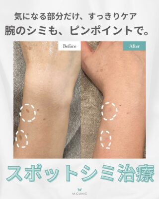 @m.clinic_official
✨気になるシミをピンポイントでケア✨

今回は、40代女性・右腕のシミ2か所にスポットシミ取りを行った症例をご紹介します。

「顔のシミは気になるけど、腕のシミも気になる…」
そんな方も実は少なくありません。

スポットシミ取りは、気になるシミにピンポイントでアプローチできる施術です。
顔だけでなく、腕などのお身体のシミが気になる方も、ぜひ一度ご相談ください💕

＼10月はキャンペーン開催中🎁／
スポットシミ取り 全顔取り放題
66,000円 → 55,000円

気になっていたシミを、この機会にケアしてみませんか？

※効果や経過には個人差があります。
※適応については診察のうえご案内いたします。

気になる方は、大阪梅田の美容皮膚科M.CLINIC (エムクリニック)までお気軽にご相談ください✨

ご予約は、WEB、LINE、お電話から承っております🥰
皆様のご来院心よりお待ちしております🫶🏻

#シミ取り #シミ治療 #スポットシミ取り #梅田美容皮膚科 #症例写真